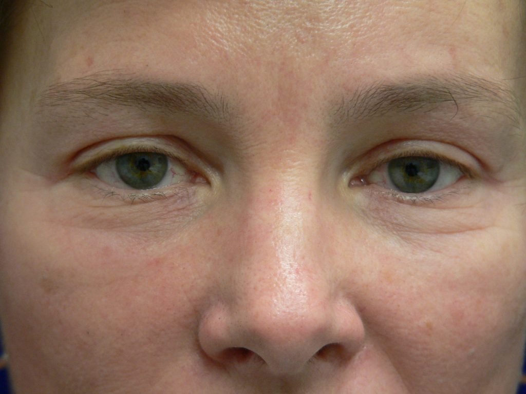 Blepharoplasty Before and After Photo