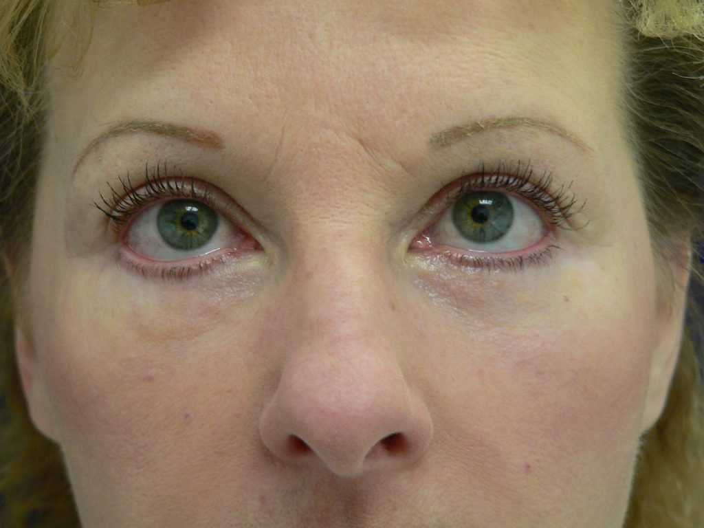 Blepharoplasty Before and After Picture