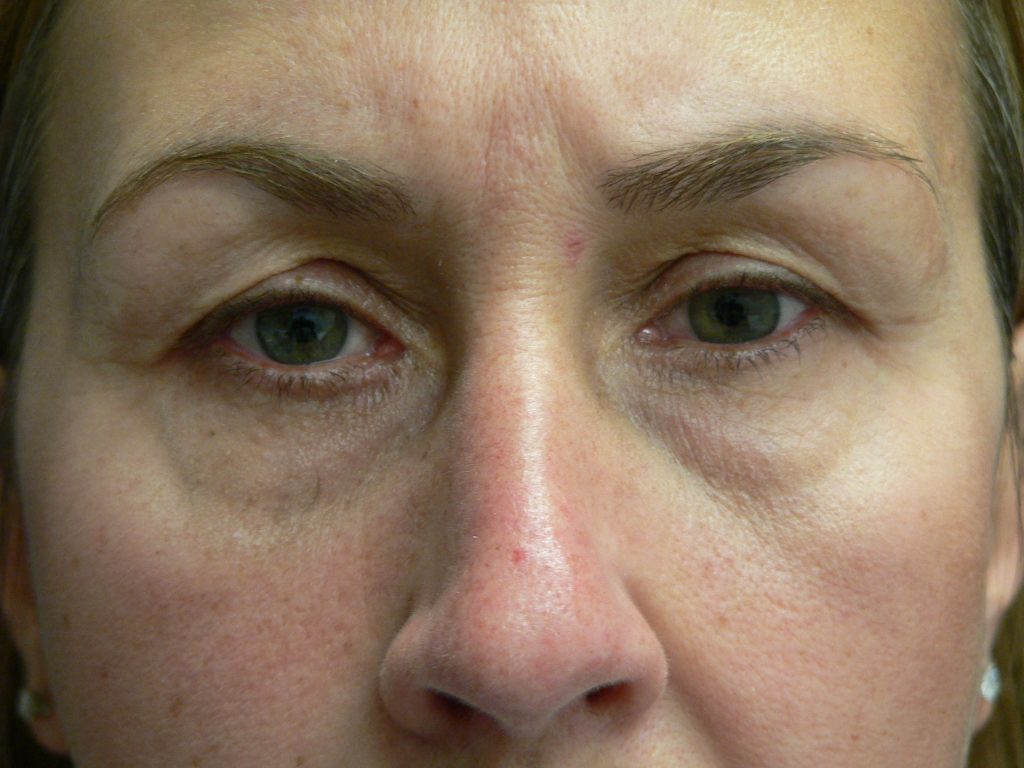 Eyelid Surgery Before and After Photos