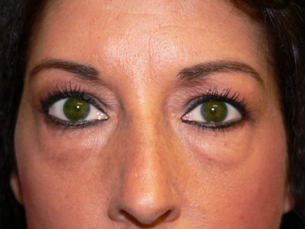 Eyelid Surgery Before and After Photos