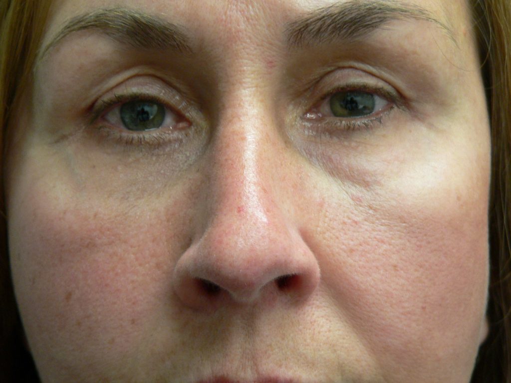 Eyelid Surgery Before and After Photos