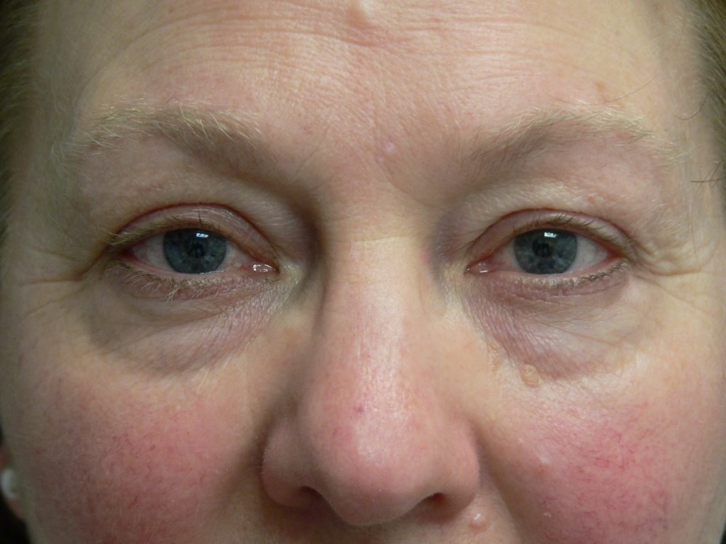 Eyelid Surgery Before and After Photos