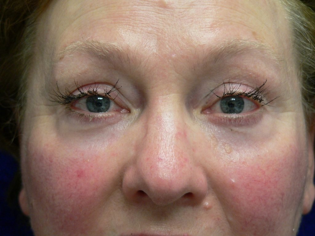 Eyelid Surgery Before and After Photos