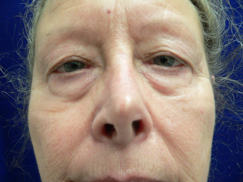 Lower Blepharoplasty