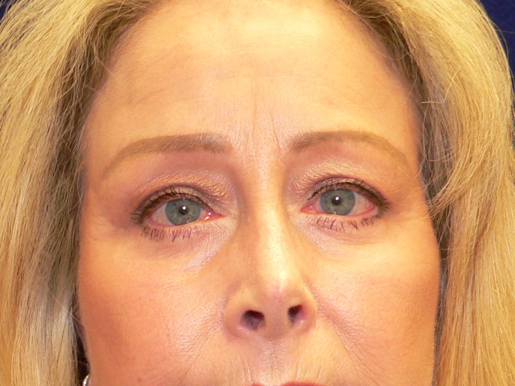 Lower Blepharoplasty