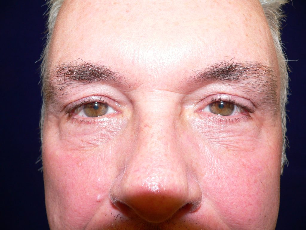 male blepharoplasty before and after
