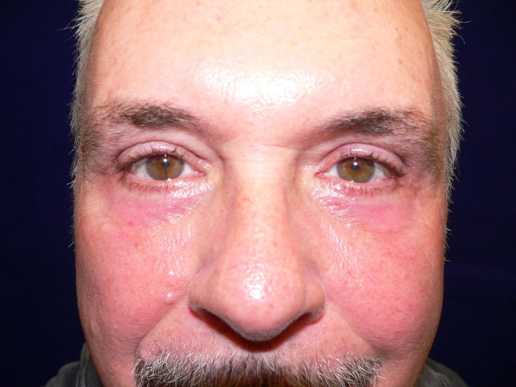 male blepharoplasty before and after