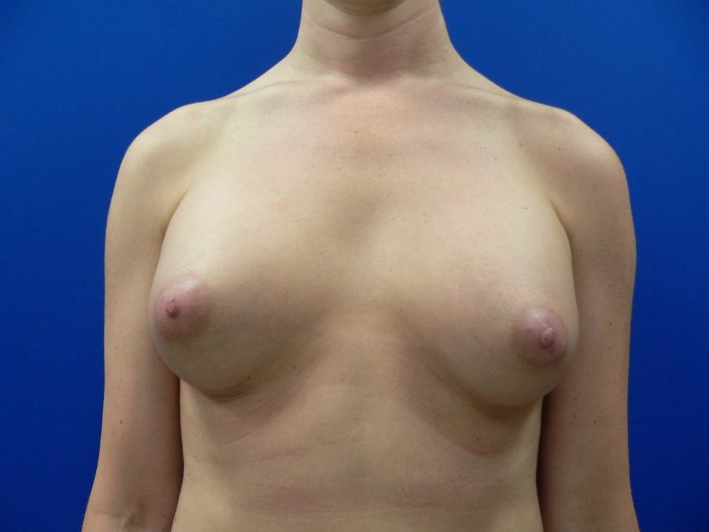 MTF Top Surgery After Photo