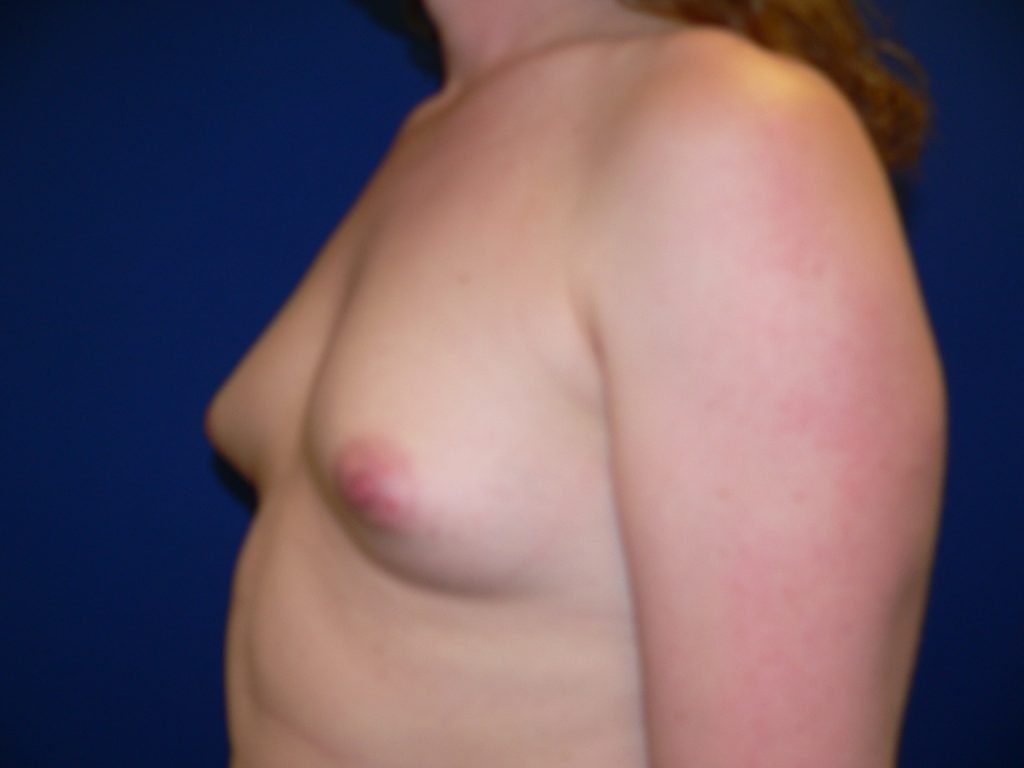 MTF Top Surgery Before Photo