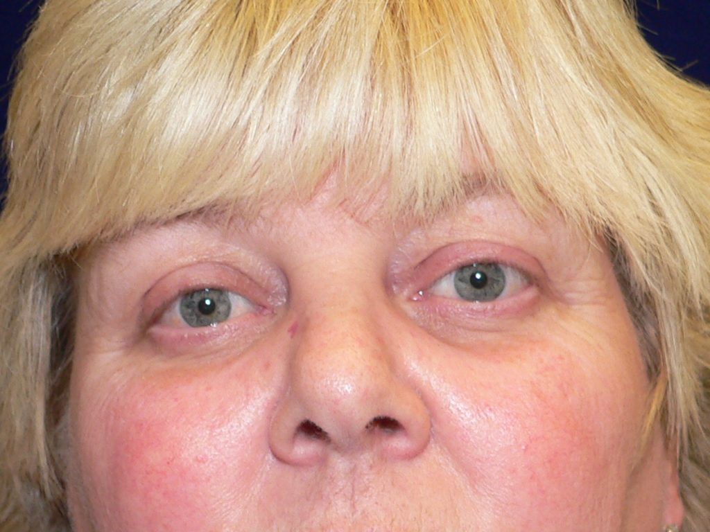 Laser Lower Blepharoplasty