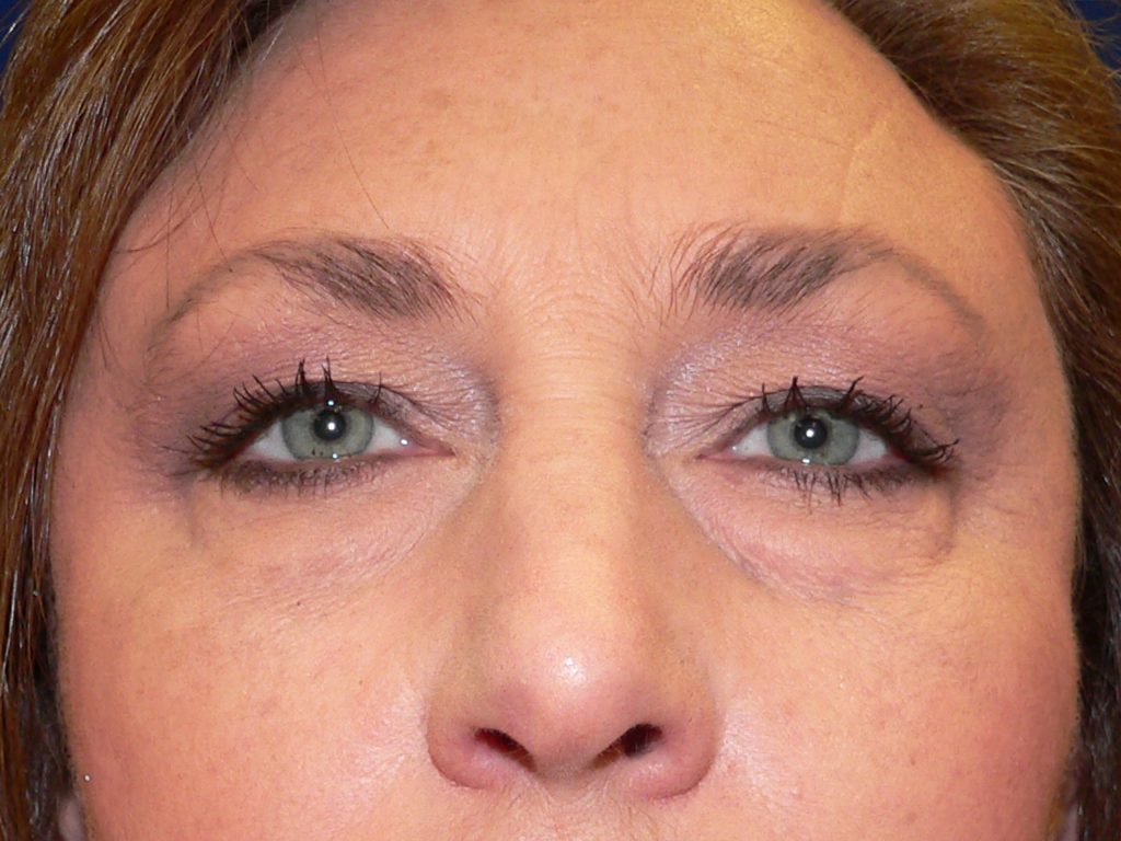 Upper Blepharoplasty Before and After