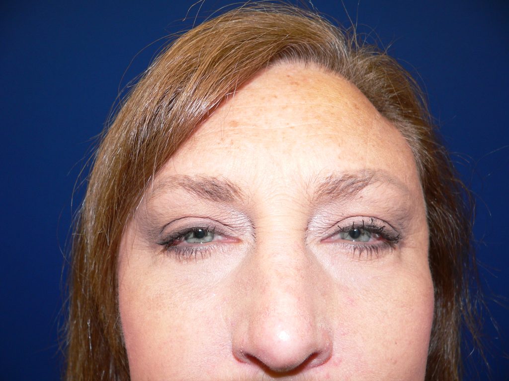 Upper Blepharoplasty