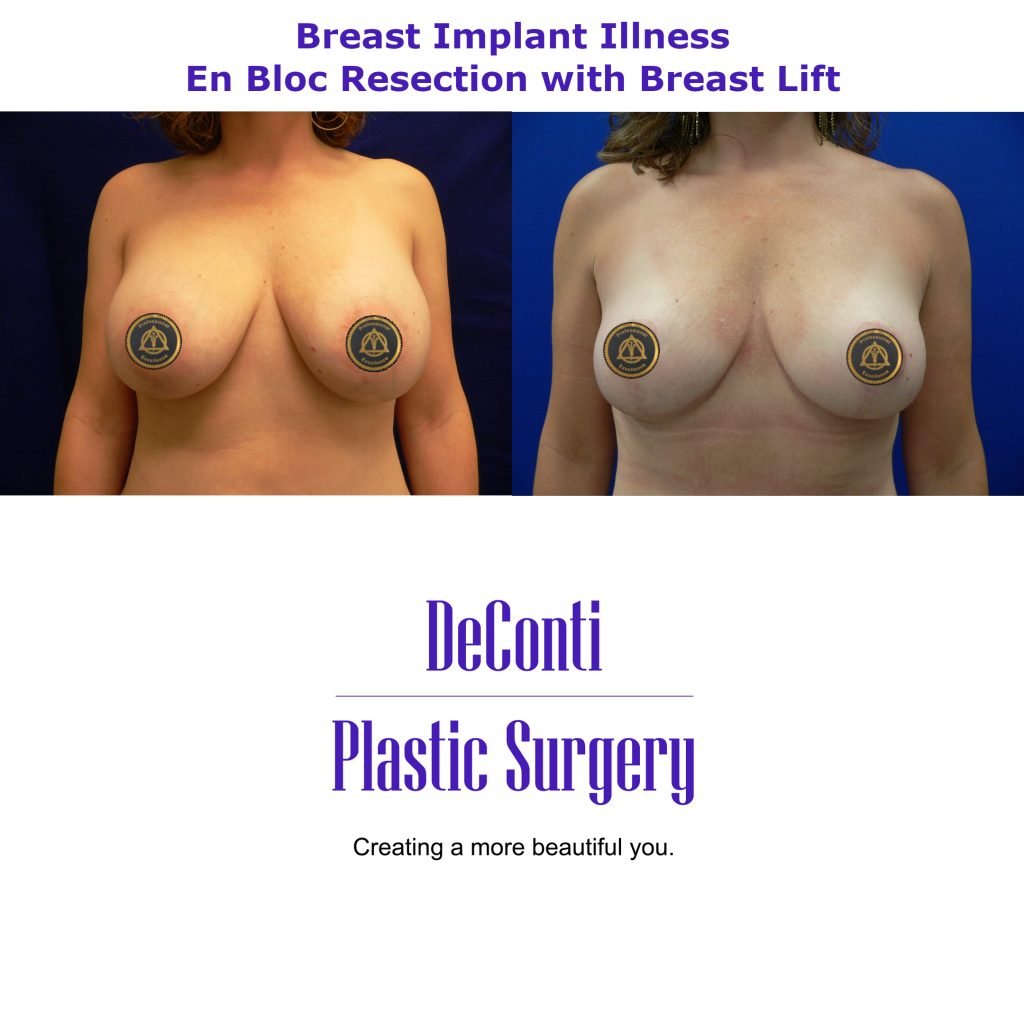 Breast Implant Removal with a Breast Lift