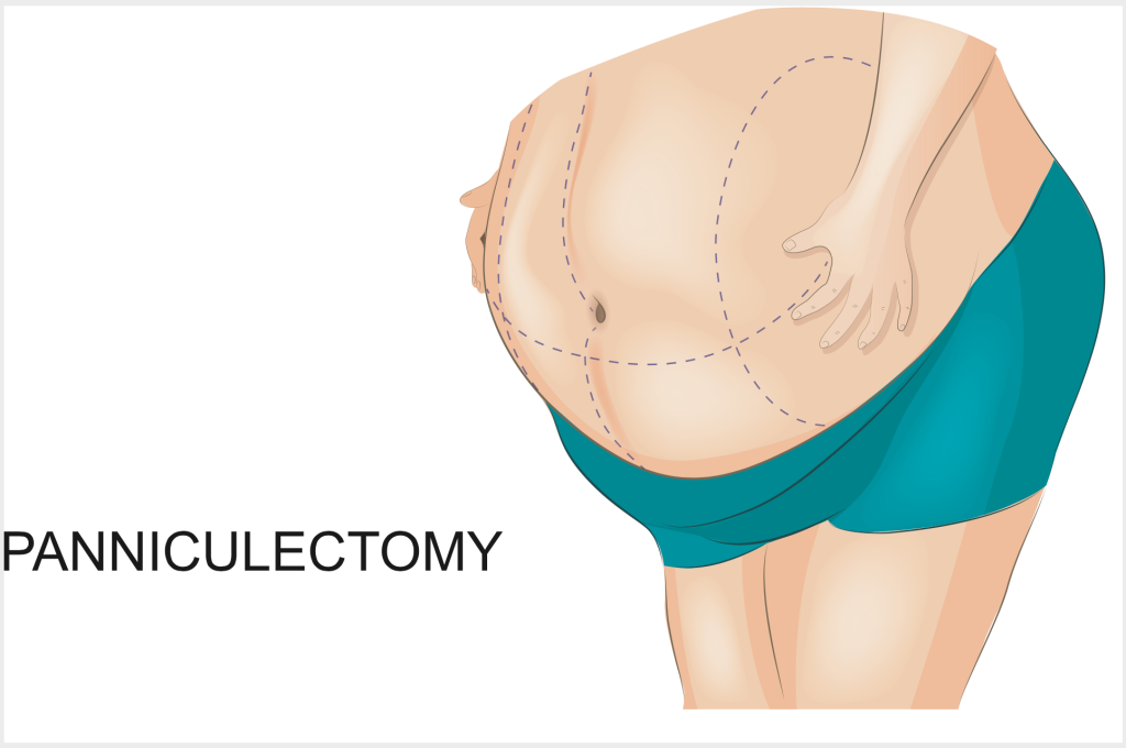 Panniculectomy Near Me