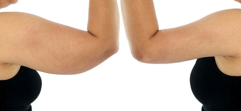 Brachioplasty Before and After