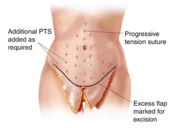 Drainless Tummy Tuck Near Me