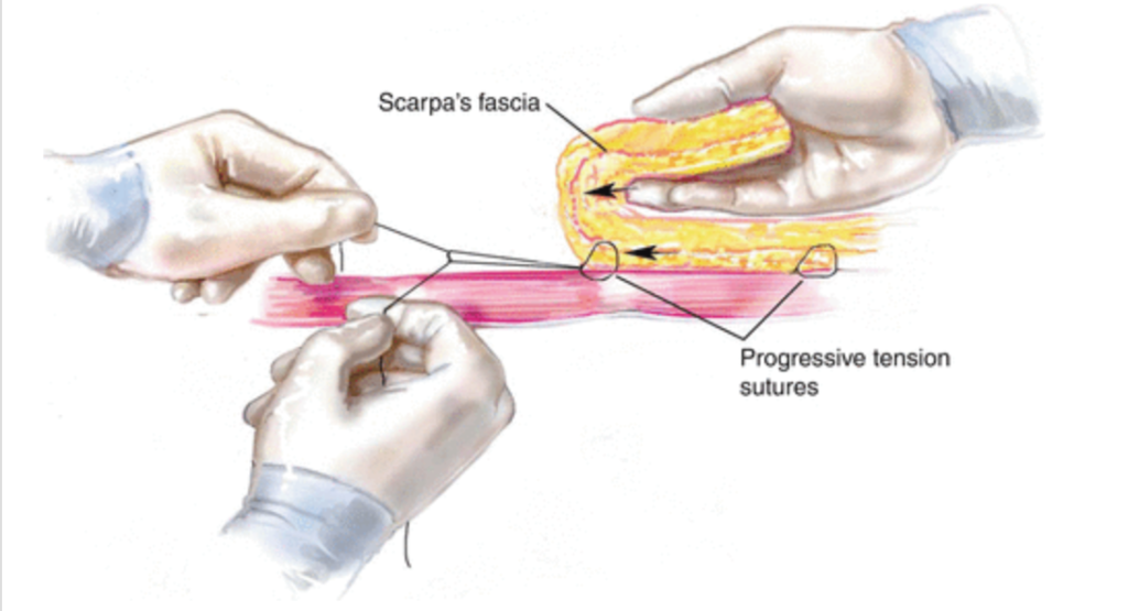 Drainless Tummy Tuck Richmond VA