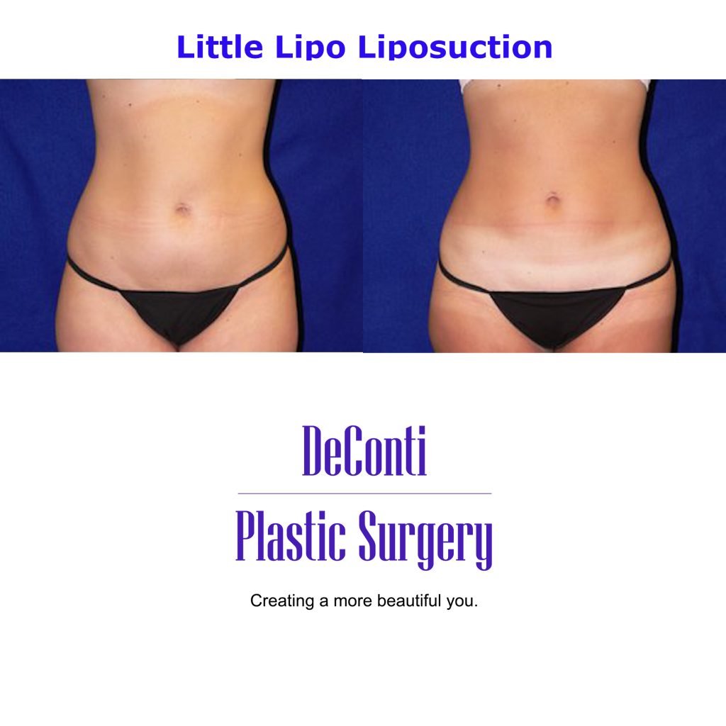 Little Lipo Liposuction
