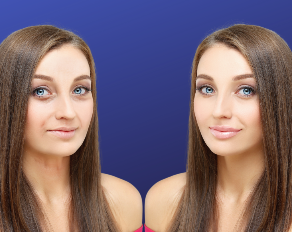 Baby Botox