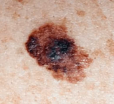 Melanoma Mole