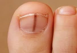 Subungual Melanoma