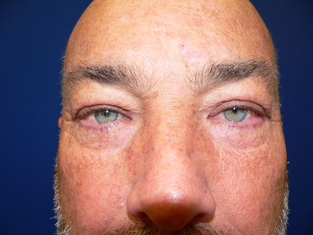 Upper Blepharoplasty Insurance Near Me