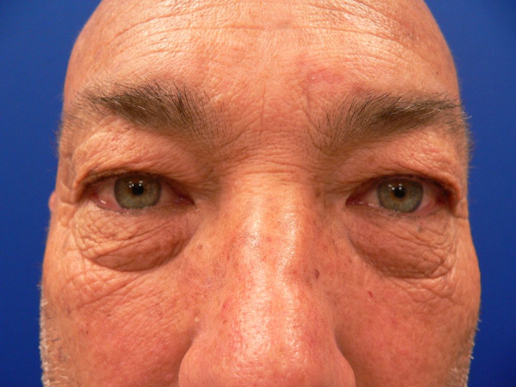 Upper Blepharoplasty Insurance