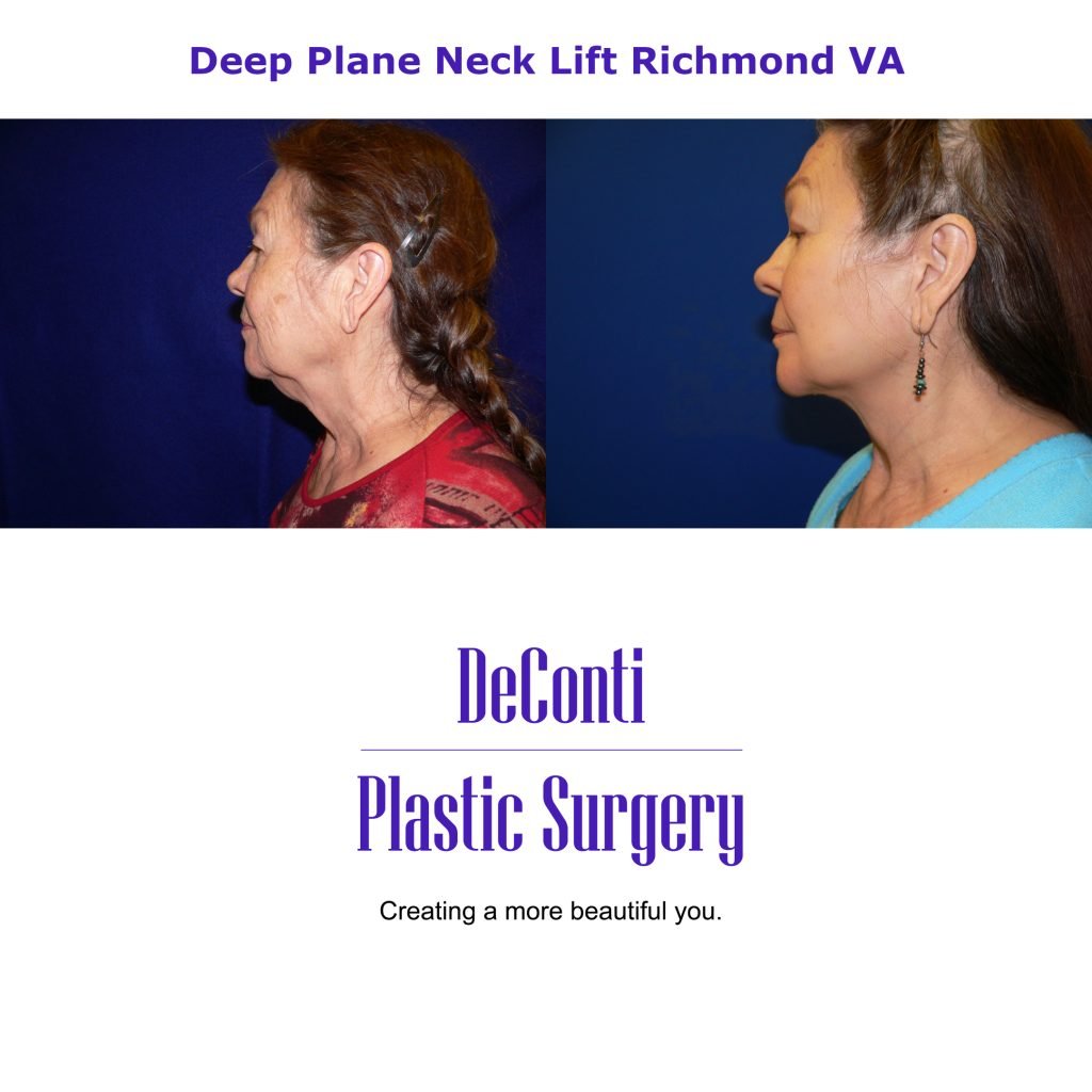 Deep Plane Neck Lift Richmond VA Short Pump VA