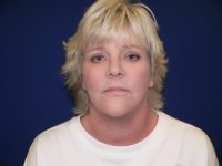 After facelift surgery results, front view showing improved facial contours, refined jawline, and rejuvenated appearance post-procedure.