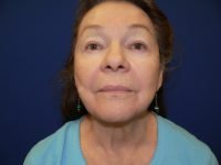 After facelift results, front view showing restored facial harmony, softened nasolabial folds, and a more contoured, youthful jawline.