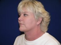 After facelift, left 45-degree angle view revealing lifted cheeks, reduced marionette lines, and natural facial rejuvenation.