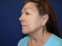 Left 45-degree result photo after facelift, highlighting lifted midface, eliminated jowls, and a natural, refreshed facial appearance.