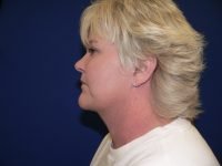 Left profile results of facelift and neck lift, showing a tightened neck, defined chin, and youthful facial profile outcome.