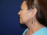 Left side profile after facelift, displaying the final surgical outcome: a graceful neckline and a clean, aesthetic angle from chin to chest.