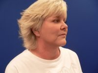 Facelift results from right 45-degree angle, showcasing restored cheek volume, softened nasolabial folds, and smoother midface.