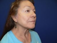 Post-operative right three-quarter view demonstrating facelift outcomes: elevated cheek volume, smoother skin, and a refined, natural jawline contour.