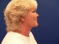 Right profile after facelift surgery, displaying a sharper jawline, improved neck contour, and refined side profile results.