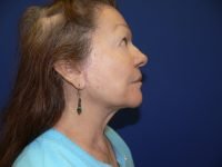 Right profile after facelift surgery, revealing a dramatic improvement with a sharp, defined jawline and a smooth, rejuvenated neck contour.