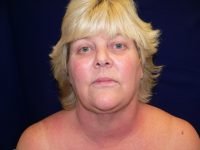 Before facelift surgery, front view of a female patient showing facial sagging, jowls, and loose skin prior to cosmetic procedure.