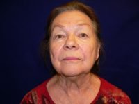 Before facelift, front view of a patient's face showing facial aging signs like midface volume loss, deep nasolabial folds, and jowl formation along the jawline.