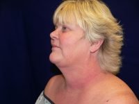 Before facelift, 45-degree angle view from the left side displaying facial volume loss, skin folds, and cheek descent.