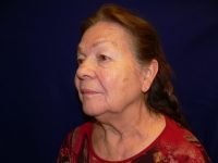 Left 45-degree angle before a facelift, illustrating descent of facial soft tissue, pre-operative jowls, and skin folds along the nasolabial area.