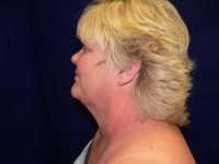 Left profile view before facelift, illustrating neck skin laxity, jawline definition, and pre-surgical facial profile.