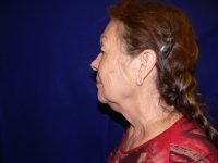 Left side profile before facelift, showcasing the patient's pre-surgical neck contour with loose skin and a poorly defined cervicomental angle.