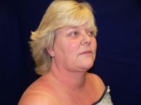 Before facelift, 45-degree angle view from the right side highlighting midface descent, nasolabial folds, and pre-surgical jawline.