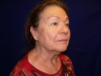 Pre-operative right three-quarter facelift photo highlighting sagging cheek tissue, marionette lines, and loss of definition in the lower face and jaw.