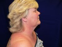 Right profile view before facelift surgery, showing neck laxity, chin contour, and pre-operative side facial anatomy.