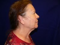 Right profile before facelift surgery, clearly displaying an undefined jawline and significant skin laxity with banding in the aging neck.