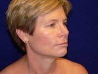 Facelift Rhytidectomy Photos