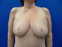 Front view of Emily after breast reduction surgery, showing improved breast contour, uplifted position, and proportional results.